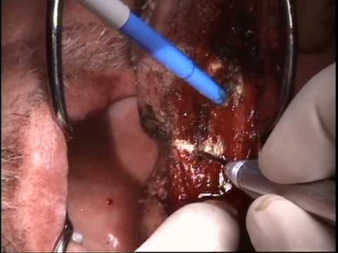 Partial Glossectomy with the OmniGuide CO2 Laser Flexible Fiber
