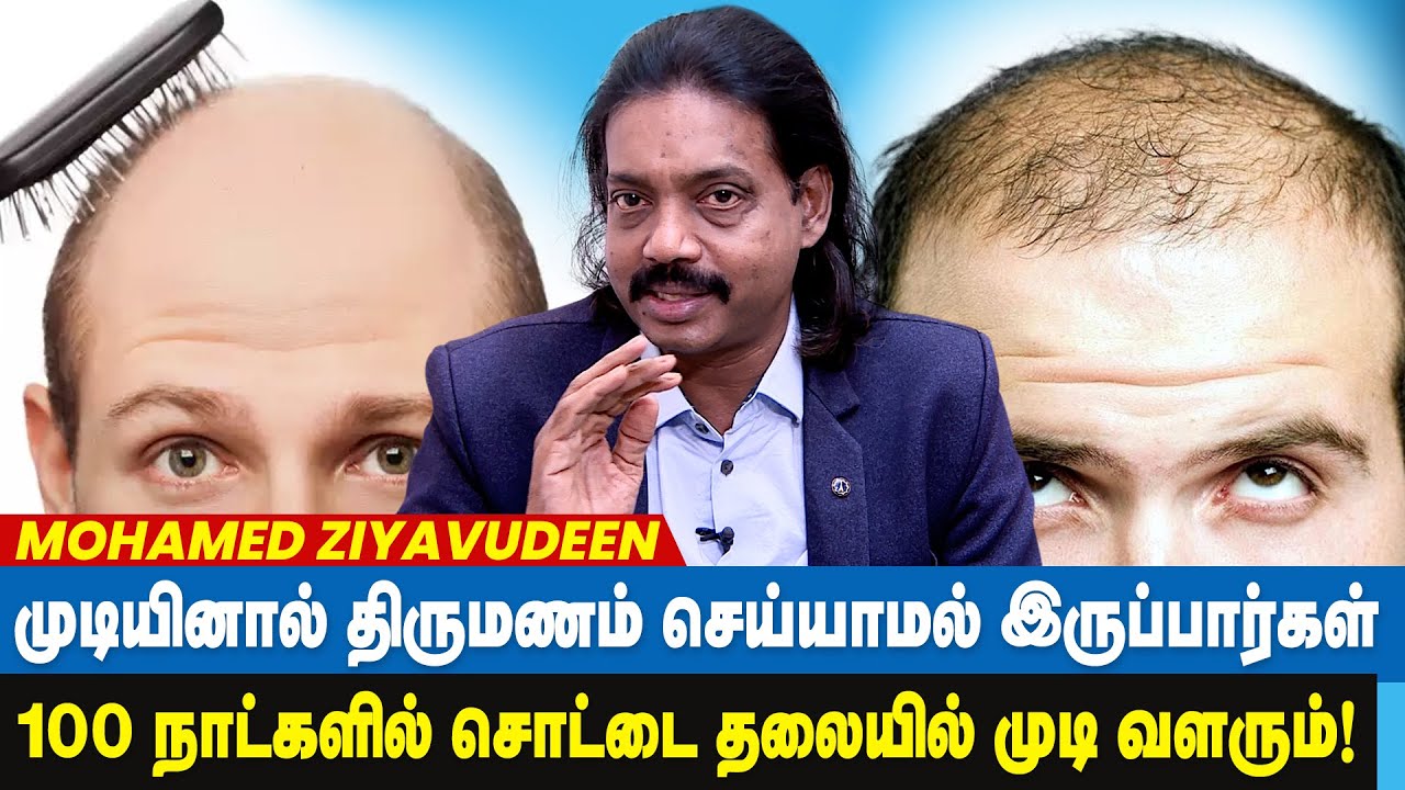 சொட்டை தலையிலும் முடி வளரும் ! Mohamed Ziyavudeen | Hair Regrowth for Men