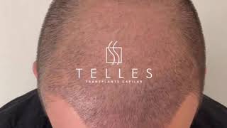 Giga Sessão de Transplante Capilar FUE - Clínica Telles Curitiba