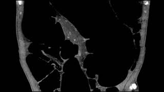 Closed loop obstruction (Ahuja AT et al; 2017) Book: Essential Radiology