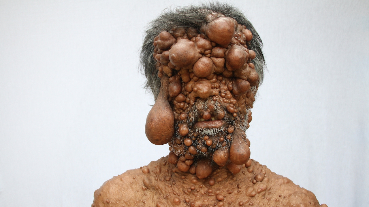 husband birthday ideas Dad’s Entire Body Is Covered In Tumours