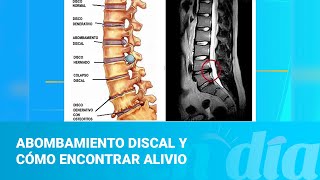 Abombamiento discal y cómo encontrar alivio