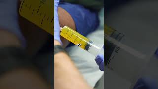 How much fluid is removed in a knee aspiration #kneepain #jointpain