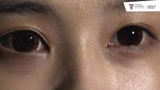 Examination of the Pupil and Pupillary responses (Dr Prabal Bhargava)
