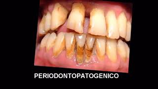 PLACA SUPRAGINGIVAL Y SUBGINGIVAL