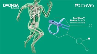 Dispositivo de fijación cortical ajustable