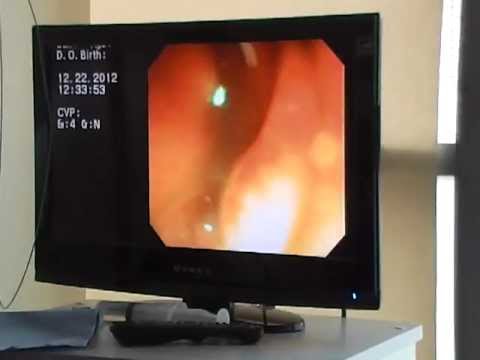 ენდოსკოპიური ლაზეროთერაპია