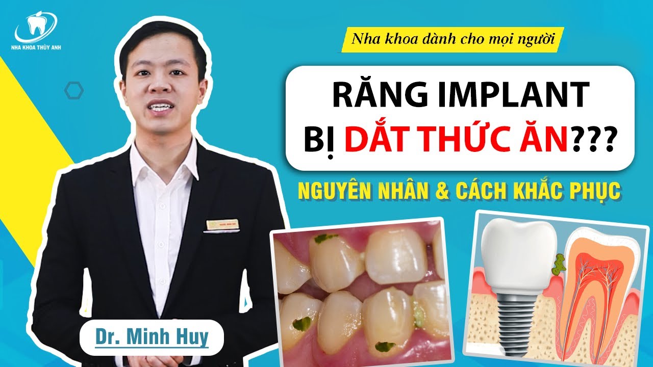 Outline Video Răng Implant bị dắt thức ăn: nguyên nhân và cách khắc phục
