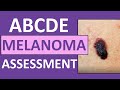 ABCDE Melanoma Skin Cancer Assessment Nursing (with Pictures)