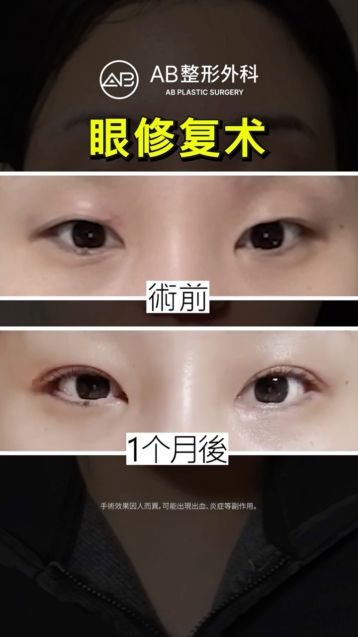 眼部整形前後對比一次看✨ #Shorts