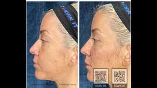 Hydrafacial Chandler AZ - Flawless Faces
