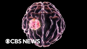 What is the aggressive brain cancer glioblastoma?