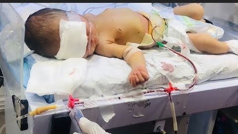 "Blood Exchange Transfusion in Newborns 🩸 | Life-Saving NICU Procedure Explained for Parents & Nurse