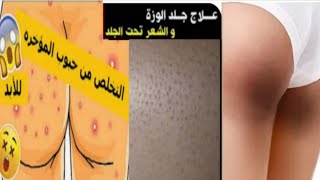 وصفه سحريه هتخلصك من كل مشاكل المؤخره أو الأرداف (اسمرار أو سواد+شعر تحت الجلد+ حبوب+ خشونة الجلد)👍👍