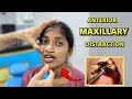 Anterior Maxillary Distraction For Jaw Correction  | Dr Parit Ladani