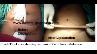 Liposuction Delhi Fat Reduction Body Reshaping India