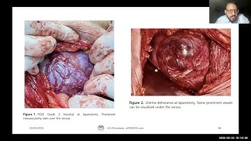 TOG Series, placenta accreta sepctrum, part 3