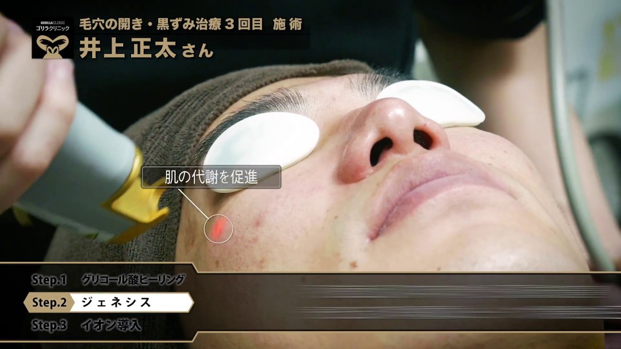 メンズスキンケア 井上正太さん03 男の毛穴の開き 黒ずみ治療 施術の流れ Youtube