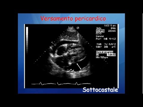 Video: Versamento Pericardico Con Tamponamento: L'ecografia Al Comodino Salva Un'altra Vita