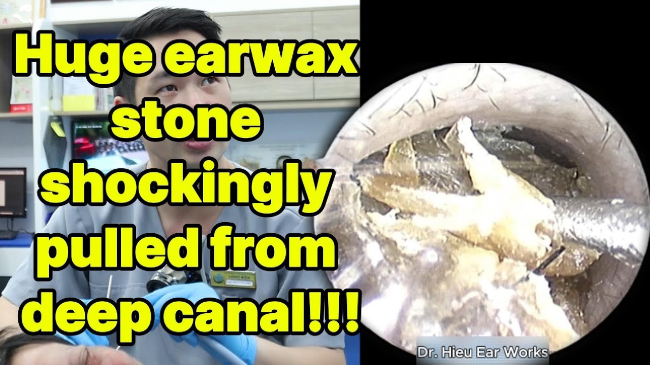 Deep Rocks For Ear Huge earwax stone shockingly pulled from deep cana | ear cleaning ...