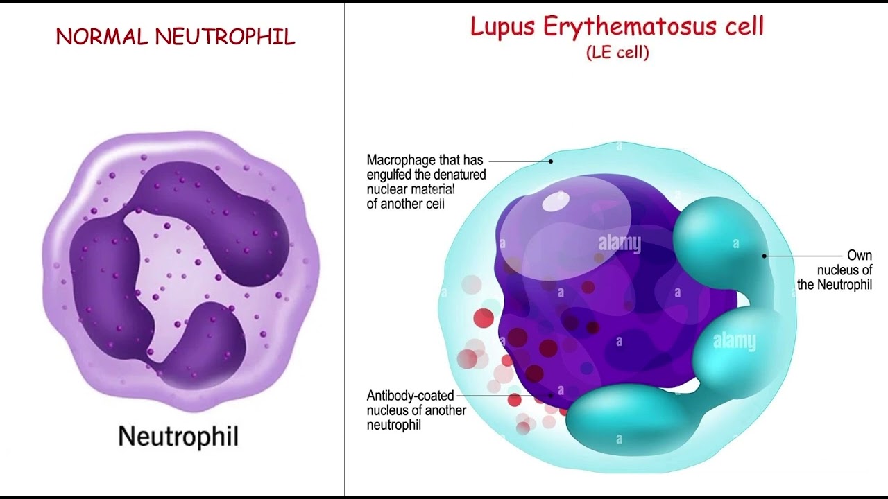 LE cell , LE body , LE cell phenomenon pathology mbbs