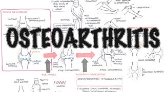 Osteoarthritis Overview (causes, pathophysiology, investigations, treatment) screenshot 5