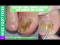 Satisfying Fungal Removal and Very Deep Compact Nail Cleaning By Miss Foot Fixer