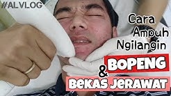 CARA MENGHILANGKAN BOPENG DAN BEKAS JERAWAT | Laser RF eMatrix V.3 | Dokterkulitku | #ALVLOG - Durasi: 17.32. 