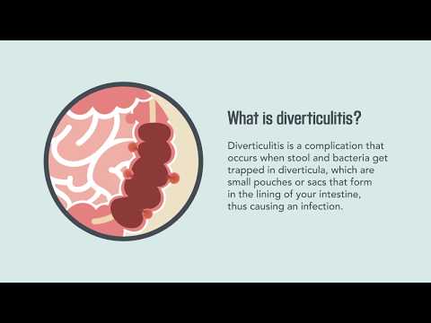 Diverticulitis: Signs, Symptoms, Causes, and Treatment | Merck Manual Consumer Version Quick Facts