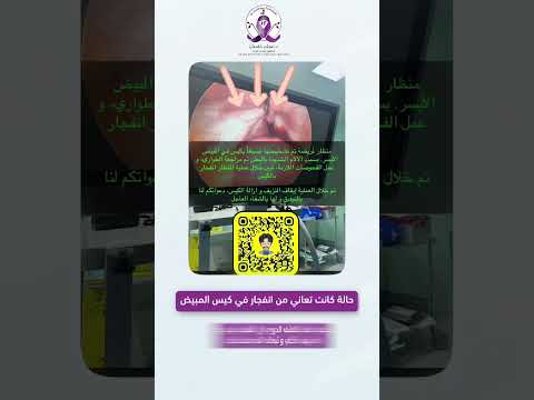 حالة كانت تعاني من انفجار في كيس المبيض فما هو السبب شاهد الفيديو لمعرفة السبب اكسبلور