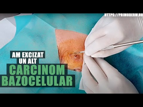 Video: Cancer De Piele (carcinom Cu Celule Scuamoase) La Pisici