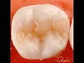 Class ii composite build up in lower first molar centripetal and cusp by cusp build up techniques