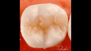 Class II Composite build up in Lower First Molar (Centripetal and Cusp by Cusp build up techniques).