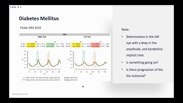 Dr.  Weber Using ERG with the RETeval to Track NPDR Progressing to PDR