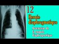 Telethorax 12  hernie diaphragmatique ascenssion de lhmicoupole diaphragmatique