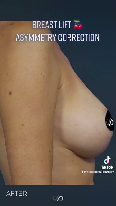 Tip: Breast Lift and Asymmetry Correction Surgery | Before and After