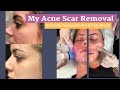 My Acne Scar Removal Journey: RF Microneedling with PRP Treatments and Results