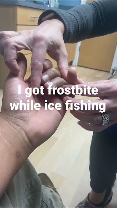 I got FROSTBITE while ice fishing #frostbite #icefishing