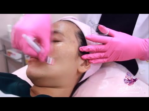 Treatment Glowing Chemical Peeling atau Chemical Peel for Acne