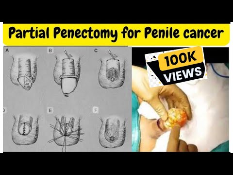 Partial Penectomy for penile cancer performed by Dr Vipin Goel