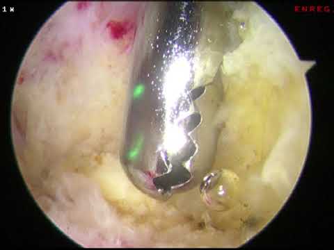 Traitement de la rupture du tendon d'achille : transfert LFH arthroscopique