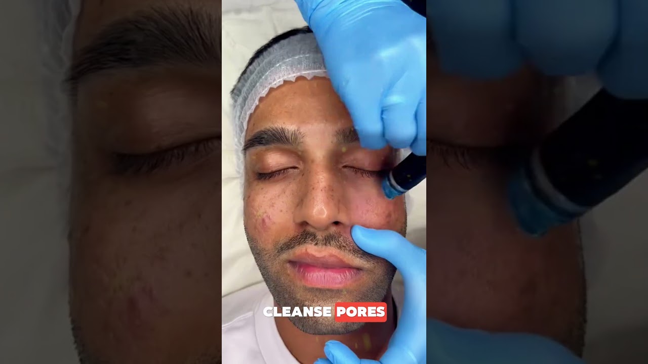 Revolutionary Oxygen Jet Peel Treatment