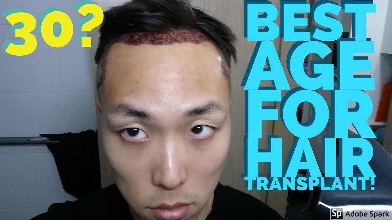 What Is The Right Age To Get Hair Transplant Treatment