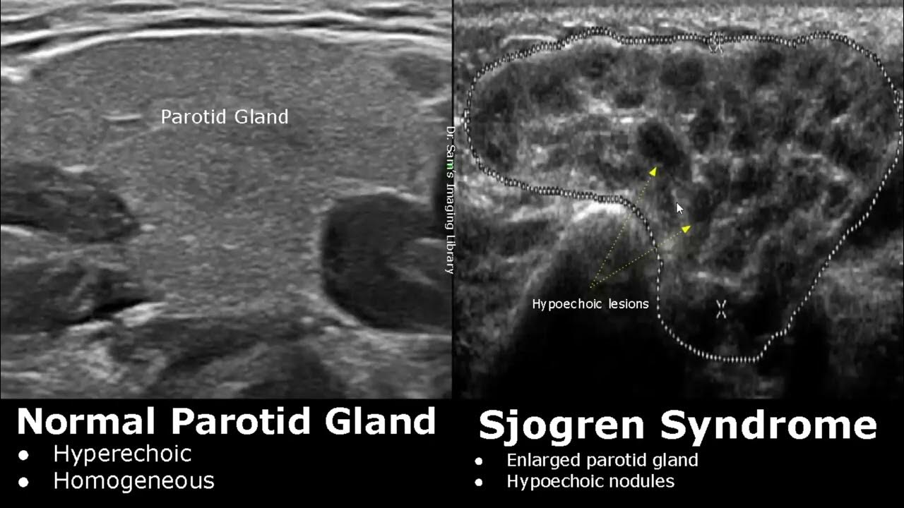 Salivary Glands Ultrasound Normal Vs Abnormal Images Parotid