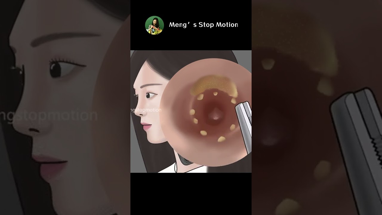 ASMR Ear cleaning👂ear wax removal animation | Meng's Stop Motion - YouTube