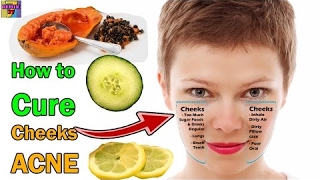 How to Remove Acne on Face (Cheeks) | Top Home Remedies - 2017 NEW