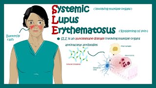 Systemic Lupus Erythematosus | signs and symptoms, pathophysiology, and diagnosis of Systemic Lupus