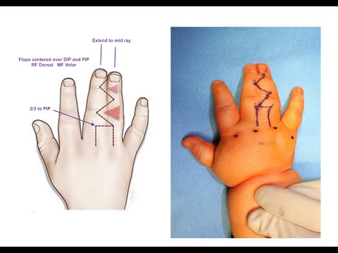 Live Surgery: Syndactyly (Webbing) Release of Fingers