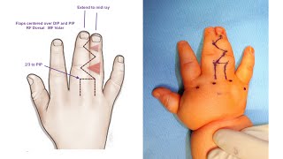 Live Surgery Syndactyly Webbing Release Of Fingers