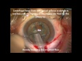 Ih during phacoemulsification cataract surgery  id 124528